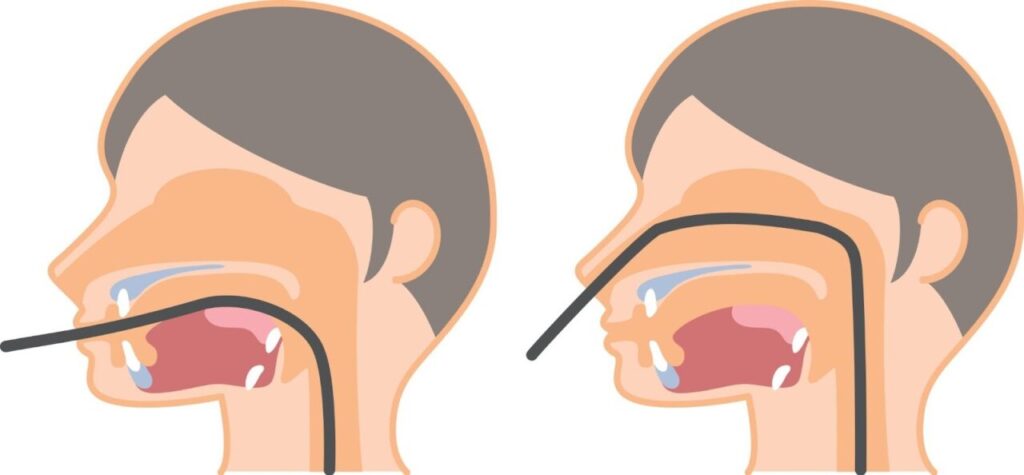 経鼻内視鏡検査と経口内視鏡検査のイラスト