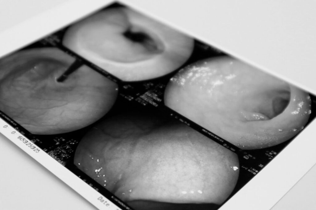 胃カメラ検査の写真