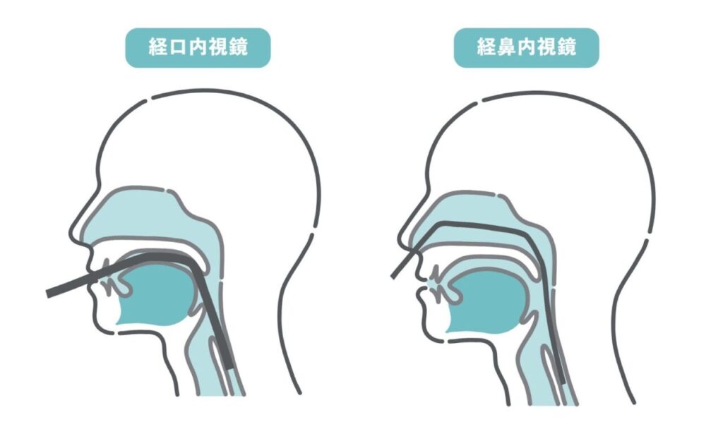 経口内視鏡検査と経鼻内視鏡検査のイラスト
