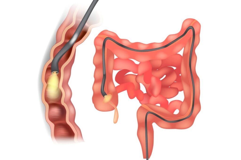 大腸カメラ検査のイラスト。腸内をスコープが通っている