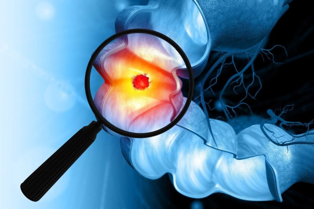 虫眼鏡で腸内の病変を発見したイメージ画像