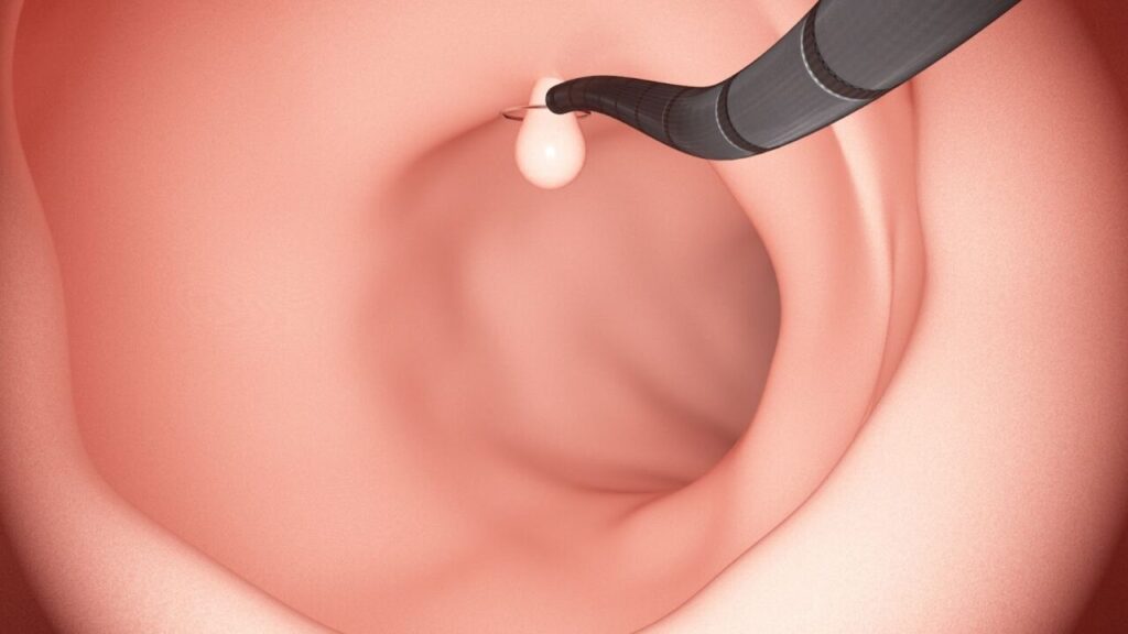 大腸カメラ検査でポリープ切除をしようとしている様子
