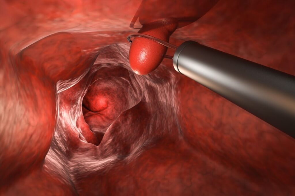 大腸カメラ検査でポリープ切除をしようとしている様子